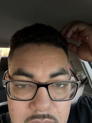 Uneven hairline