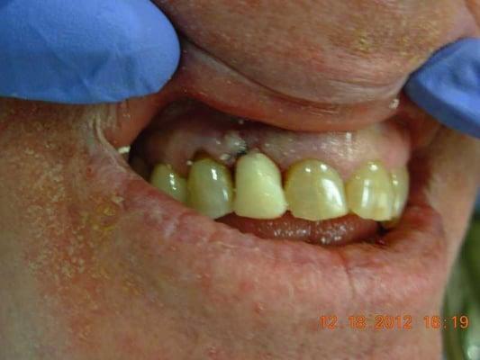 tooth be extracted and an implant with temporary crown place at the same day