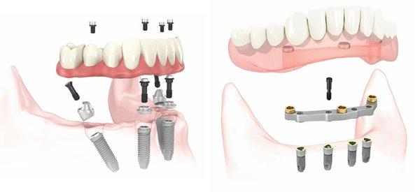 All-on-4 implants