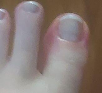 Infected toe after pedicure.