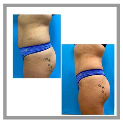 Exilis and emsculpt treatments don't to abdomen and butt.