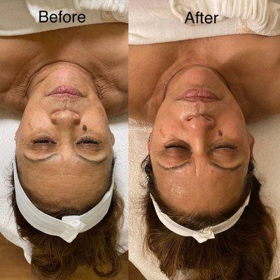 Before and after triple later facial