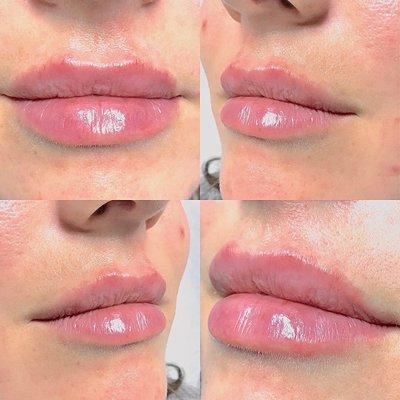 Lip filler with Versa