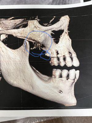 My fractured ridgeline and shards of jaw that needed reparative surgery after Dr Padillas care of my mouth.