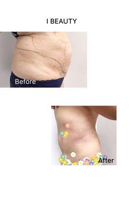 liposuction