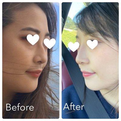 Nose fillers before and after.