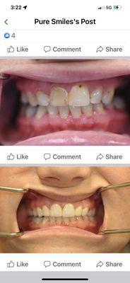 Crowns and partials to enhance the smile