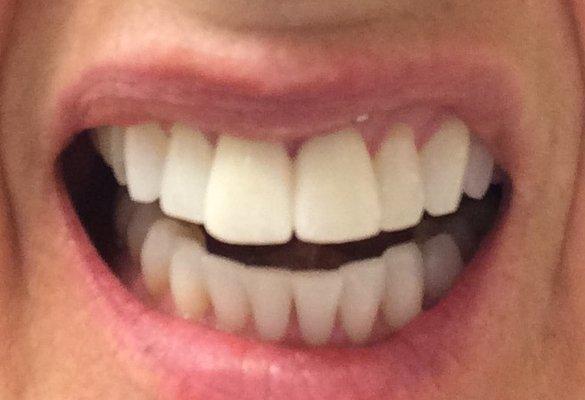 1st set of overlapping thick, wide hideous center veneers from lab. Looked like fake chicklet chalk teeth. Traumatizing. Avoid cosmetic work