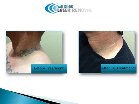 Tattoo Removal San Diego