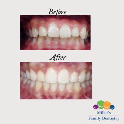 Some people have a "overbite," a common orthodontic condition where the top teeth significantly cover the bottom. Invisalign to the rescue!