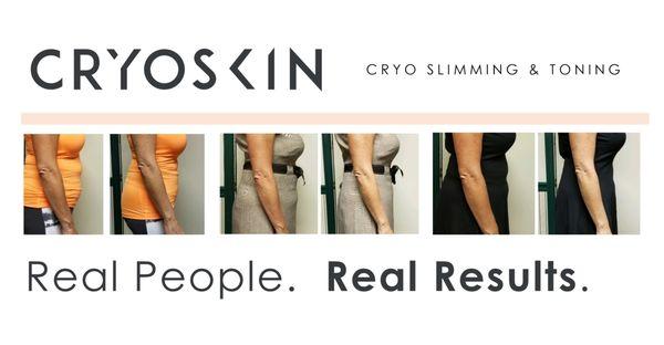 CryoSlimming results