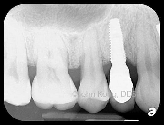 Dental Implant