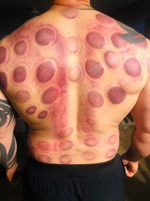 Therapeutic Cupping