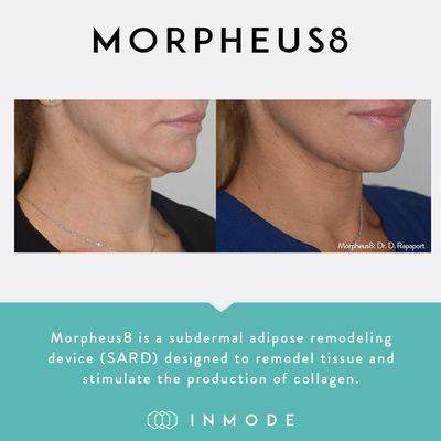 Miami Skin Spa is offering Morpheus 8 Packages to help you achieve the results you are looking for in just 3 to 4 treatments.