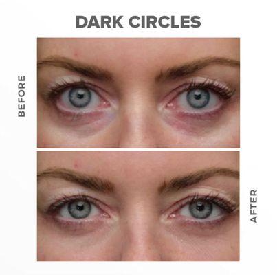 Dark circle reduction for the under eyes