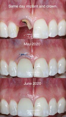 Same day/immediate implant and crown