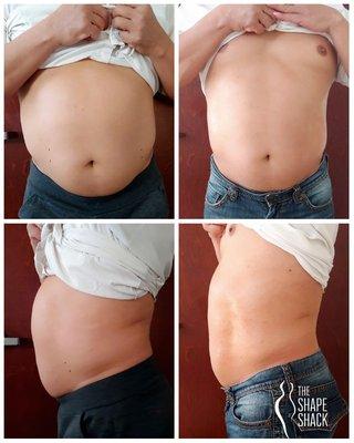 Great results from only two full treatments (90 min) and 4 mini LipoSculpt sessions (20 min).