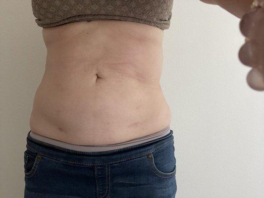 Wave did liposuction on my waistline. Both sides were uneven I told them to fix it and they want me to pay thousands.