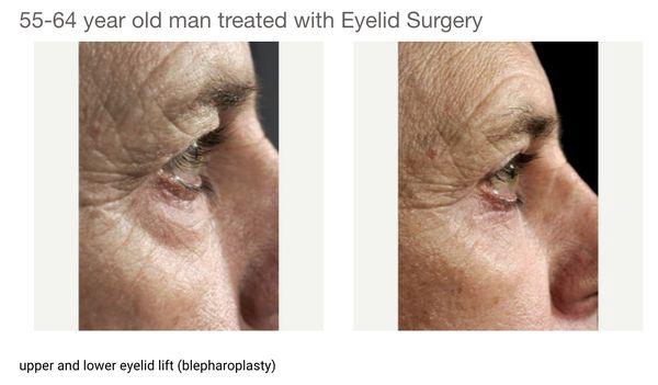 Eyelid Surgery