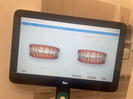 Invisalign Simulator