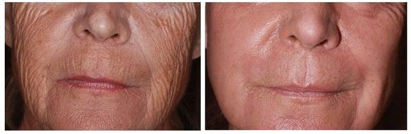 Laser Skin Rejuvenation - Before & After: Performed by Dr. Goldberg