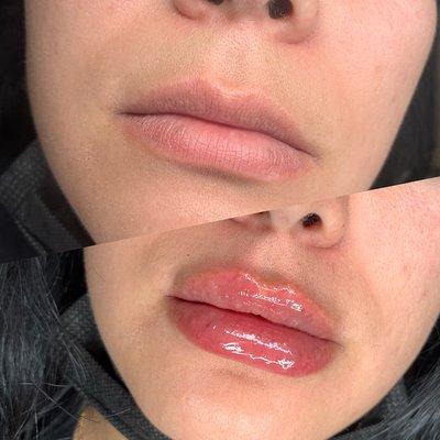 No Needle Lip filler