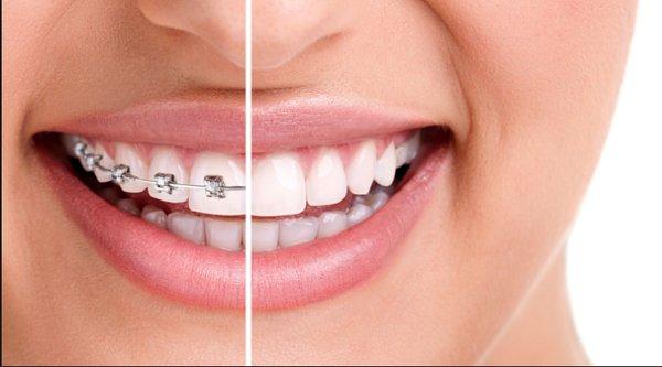 Invisalign Oceanside, CA