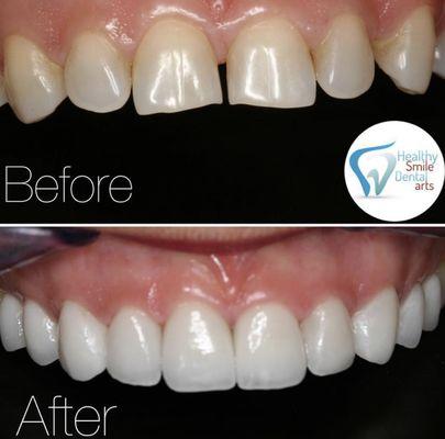 Dental porcelain veneers are placed to correct worn enamel, uneven tooth alignment/spacing, cracks, discoloration, etc.