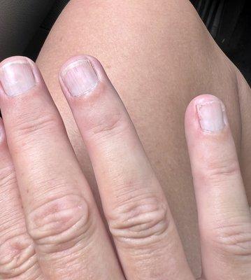 Extremely poor manicure and improper gel removal.