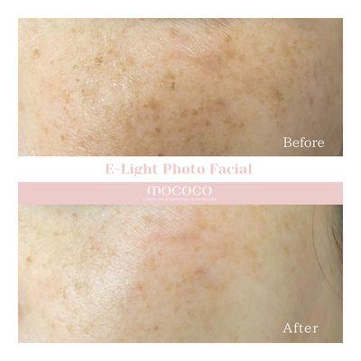 E-Light Photo Facial to improve skin turnover