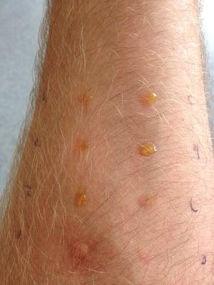 Allergy testing