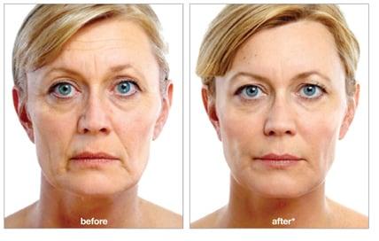 Voluma for a ninsurgical facelift!