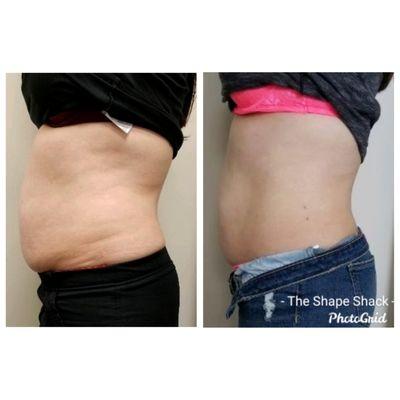 6 sessions of Laser Lipo Sculpt, Ultrasonic Cavitation, & Therma Lift 
 *Results may vary