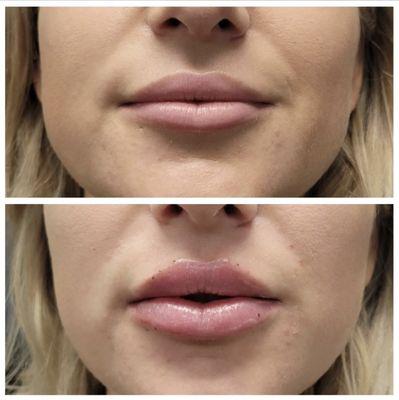 Before and after lip filler using Restylane Kysse.