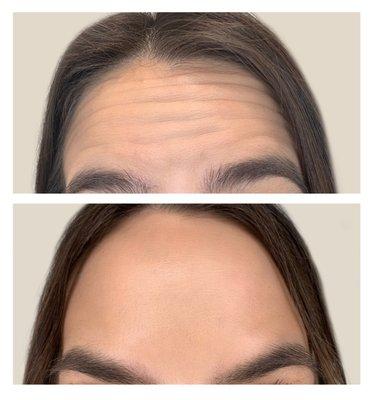 Botox Treatment - Before and After