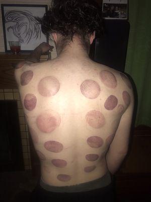 Post Cupping Therapy