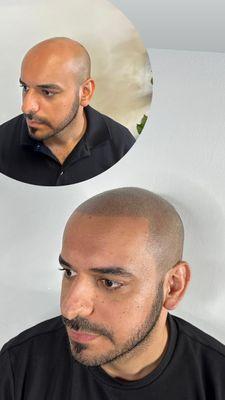 Scalp micropigmentation before and after front hairline