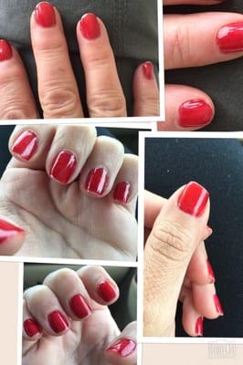 The top two pics are my mothers nails the next morning. The bottom are mine. Notice how uneven the thumb is.