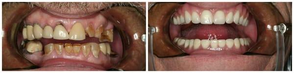 Restorative dentistry procedures