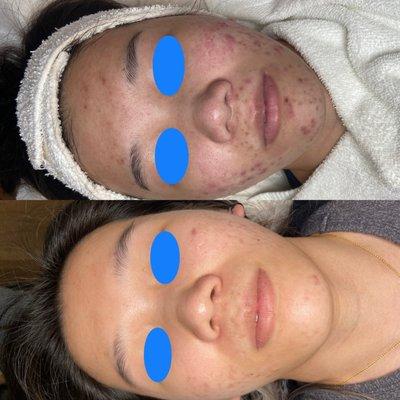 Before and After acne program