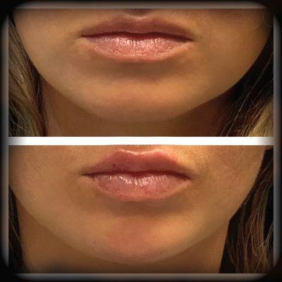 Lip Filler