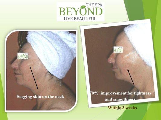 # 1 SPECIALIZED in HIFU-Ultherapy for the Neck and Jowls Trial: $499(Org: $1,500) with 200 lines)