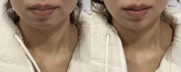 Chin Filler before and after contrast.