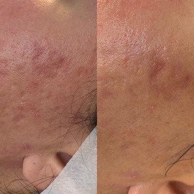 Skin revision for acne scarring