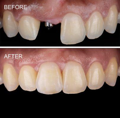 Implant & crown replaces missing front tooth, central incisor