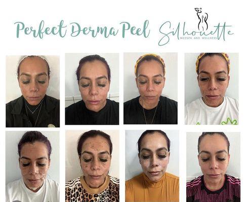 Transform your skin in one week with our Perfect Derma Peel. This treatments helps reduce  hyperpigmentation and improve clarity of the skin