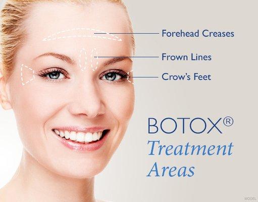 Botox injection- winkle removal of forehead, frown lines and Crow's feet