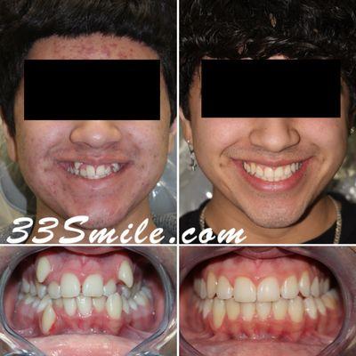 Invisalign at Cosmetic Dental Associates.