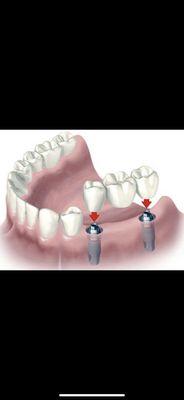 Implant restoration (fixed bridge)