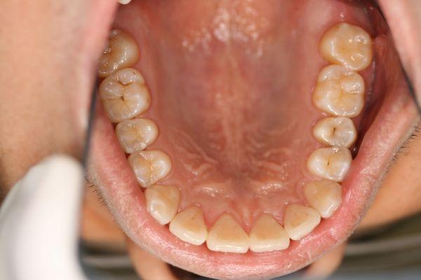 Invisalign Treated Lower Teeth